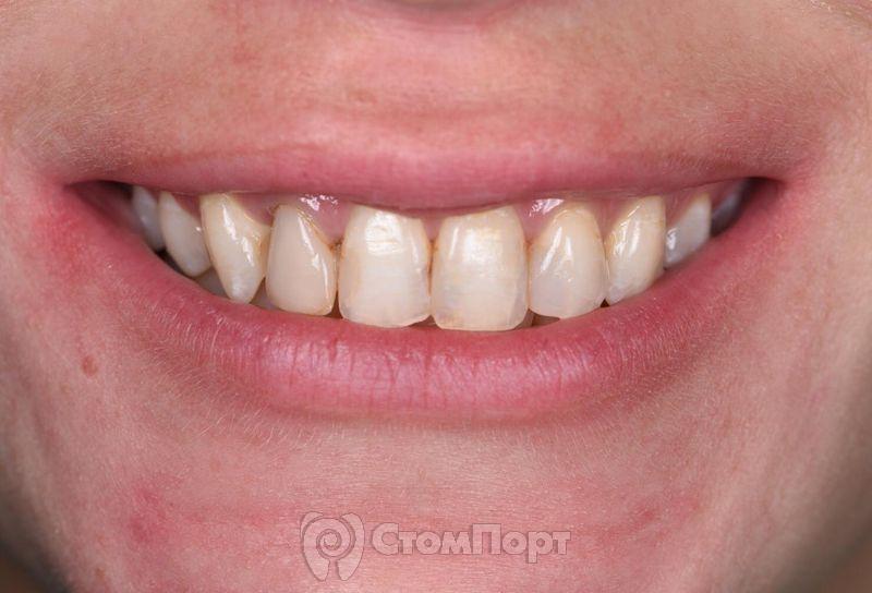 Реставрация верхних резцов с исправлением осей зубов-5