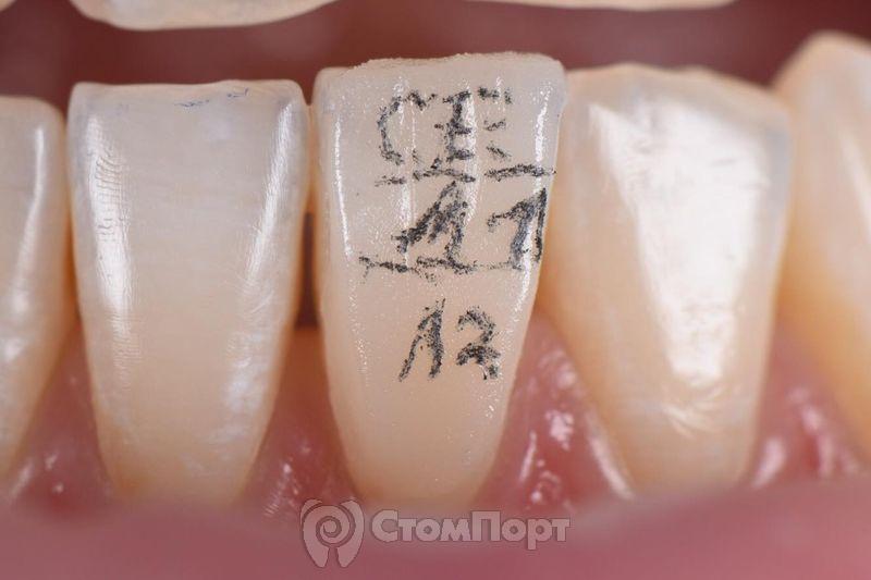 Реставрация верхних резцов с исправлением осей зубов-6