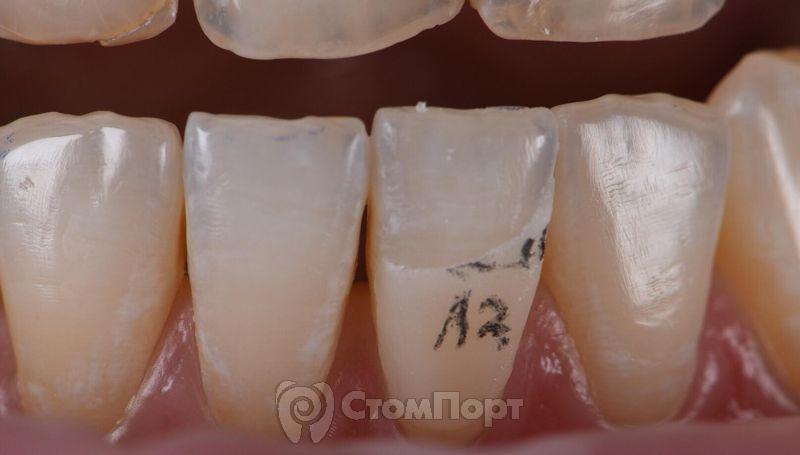 Реставрация верхних резцов с исправлением осей зубов-7