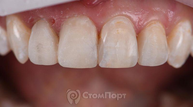 Реставрация верхних резцов с исправлением осей зубов-8