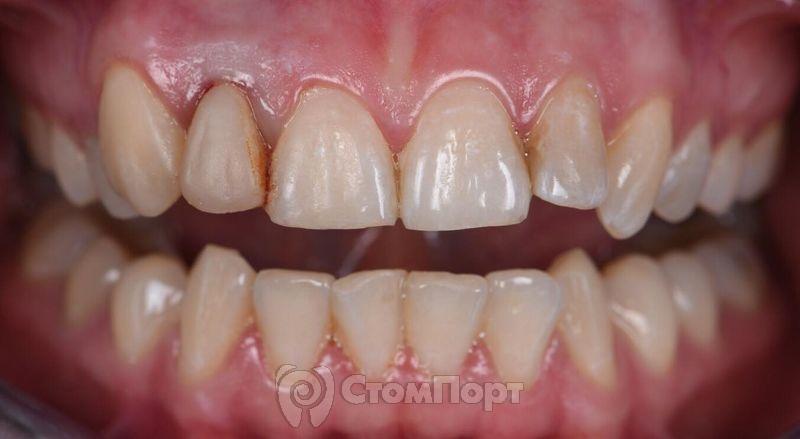 Реставрация зуба с использованием красок-1