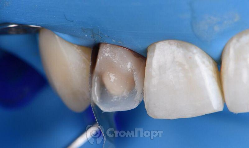 Реставрация зуба с использованием красок-11