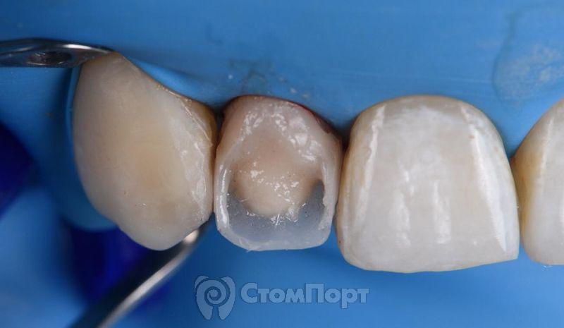 Реставрация зуба с использованием красок-12