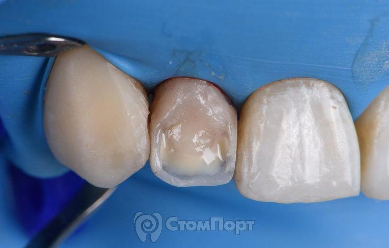 Реставрация зуба с использованием красок-13