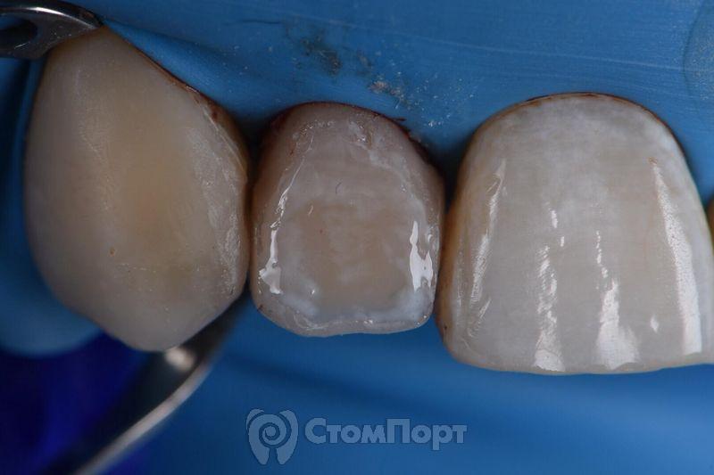 Реставрация зуба с использованием красок-14