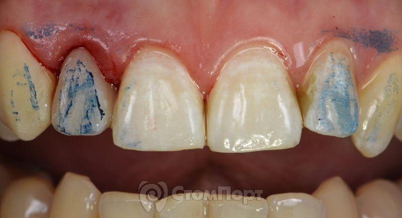 Реставрация зуба с использованием красок-15
