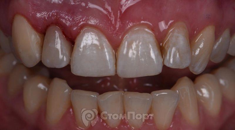 Реставрация зуба с использованием красок-16