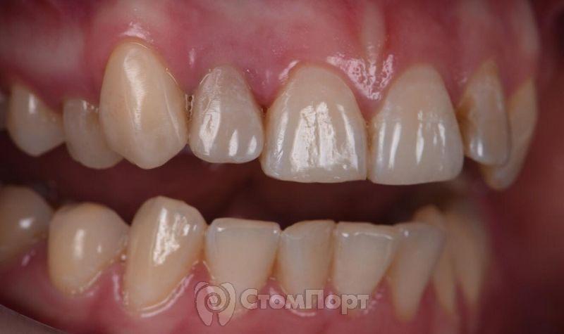 Реставрация зуба с использованием красок-19