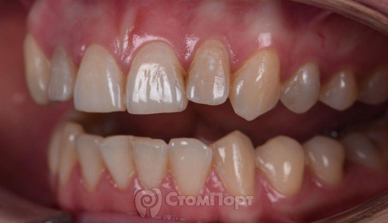 Реставрация зуба с использованием красок-20