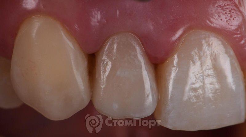 Реставрация зуба с использованием красок-22