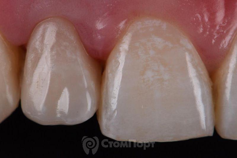 Реставрация зуба с использованием красок-24