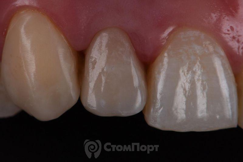 Реставрация зуба с использованием красок-25