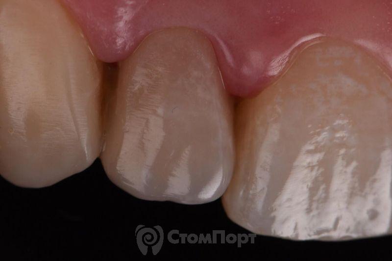 Реставрация зуба с использованием красок-26