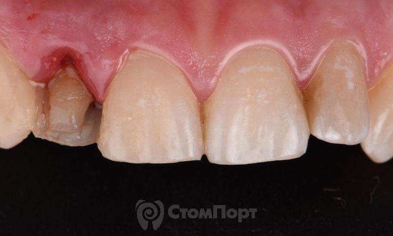 Реставрация зуба с использованием красок-3