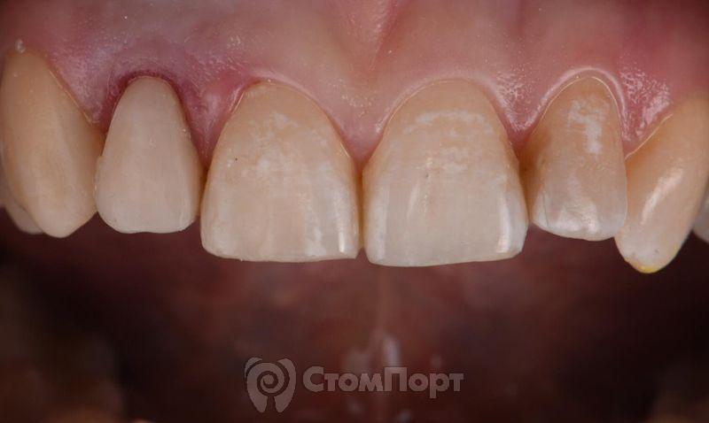 Реставрация зуба с использованием красок-4