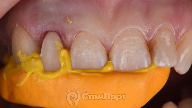 Реставрация зуба с использованием красок-5