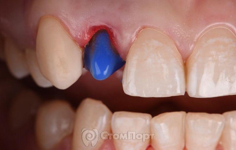 Реставрация зуба с использованием красок-7