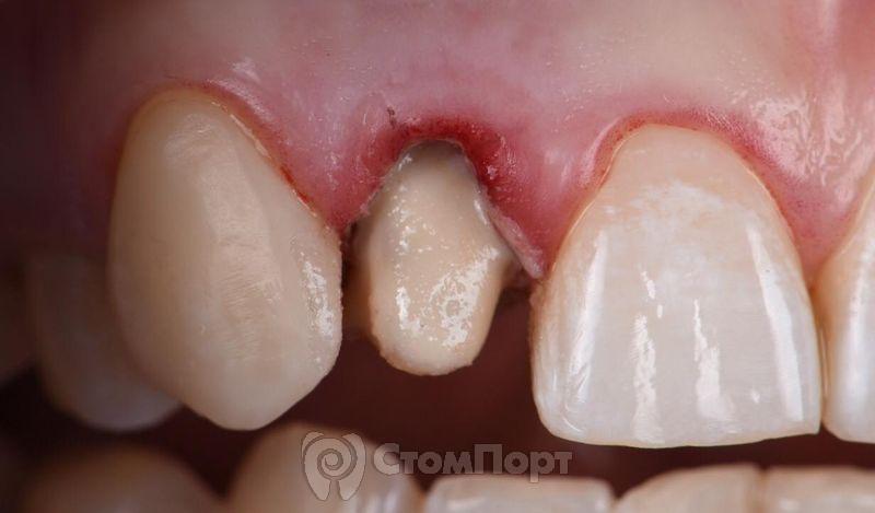 Реставрация зуба с использованием красок-8