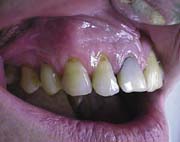 Рис.10. Клиновидный дефект в области 13 зуба