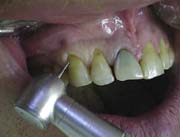 Рис.12. Механическая обработка поверхности зуба