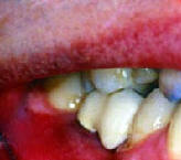 Рис.4. Вид коронки, фиксированной на имплантате в полости рта