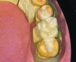 Рис. 11. Форма зуба анатомически моделируется из воска