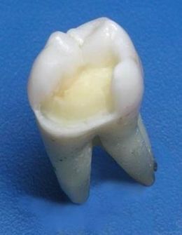 26 зуб, этап препарирования