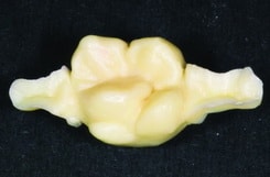 Рис. 13. Готовая восковая моделировка соответствует натуральной форме зуба