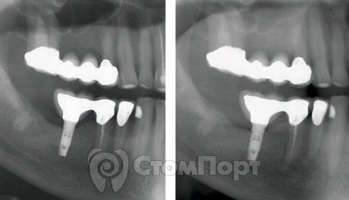 Рис. 1 Потребность в объединении имплантата и натурального зуба в одной конструкции