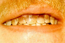 Рис. 1 Вид передних зубов верхней челюсти до обработки
