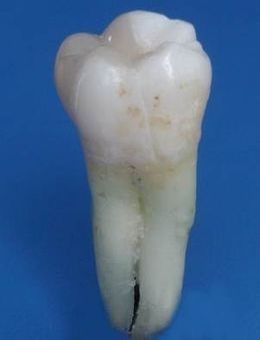 Вестибулярная поверхность 26 зуба