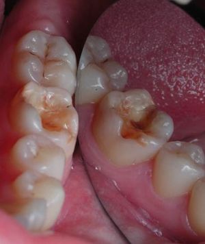 Кариес дентина 36 зуба