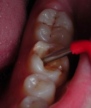 Электроодонтометрия 36 зуба