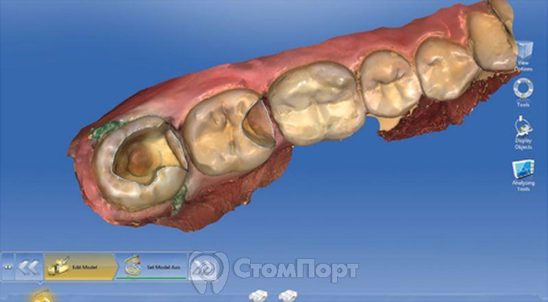 Рис. 2 Вид скана отпрепарированных зубов на программе Cerec