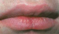 Пациент К., полное заживление трещины губы после 4 сеансов комплексного лечения