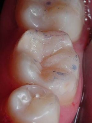 Контроль окклюзионных контактов в области 36 зуба