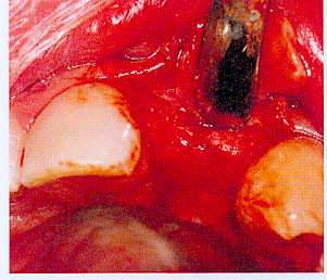 Рис. 3 Отсутствие одного зуба с узким гребнем