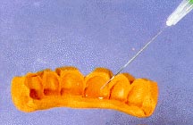 Рис. 4 Одна или две капли пластмассового мономера наносятся на оттиск каждого зуба жидкостным аппликатором