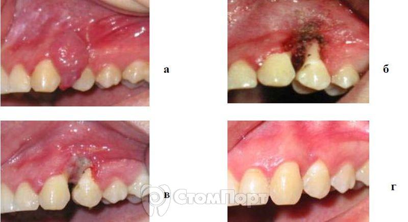 Фиброматозный эпулис в области 23, 24 зубов