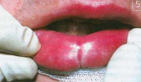 Пациент С, наблюдение в динамике комплексного лечения. Состояние нижней губы после 2 сеансов лечения
