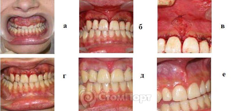 Лечение гипертрофического гингивита средней степени тяжести в области фронтальной группы зубов на верхней челюсти