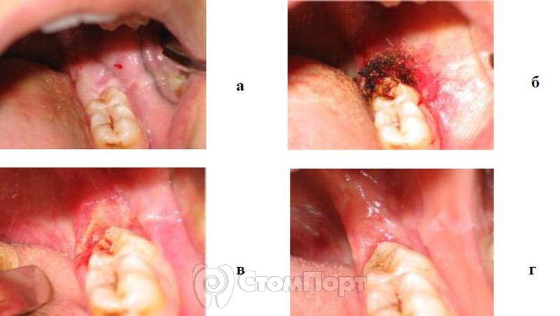 Лечение хронического рецидивирующего перикоронита в области 38 зуба