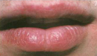 У пациента полное заживление трещины губы после 8 сеансов комплексного лечения