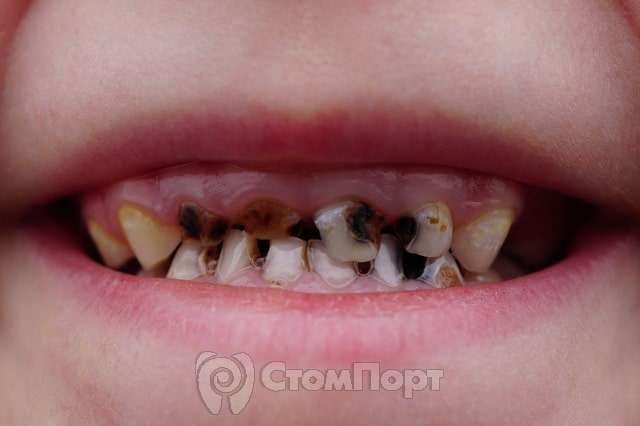 Почему темнеют или чернеют зубы у ребенка?