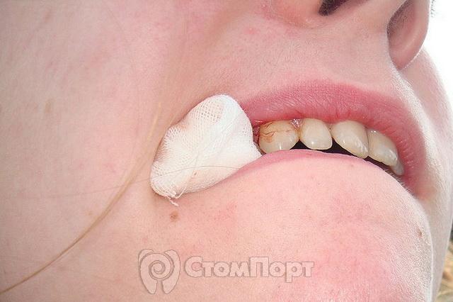 Кровотечение после удаления зуба