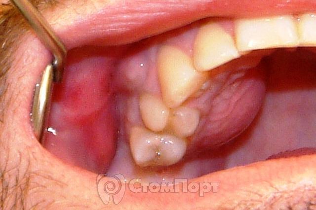 Зубной абсцесс или гнойник — что за зверь?