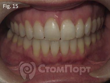 Ускоренная ортодонтия-15