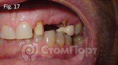 Ускоренная ортодонтия-17