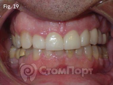 Ускоренная ортодонтия-19