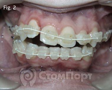 Ускоренная ортодонтия-2